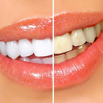 Как отбелить зубы на фото онлайн