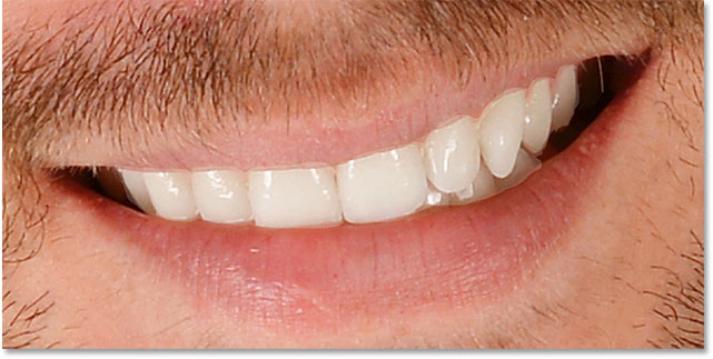 The teeth have been whitened but areas around them need to be cleaned up.