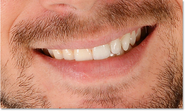A before and after comparison after removing the yellow in the teeth to whiten them in Photoshop