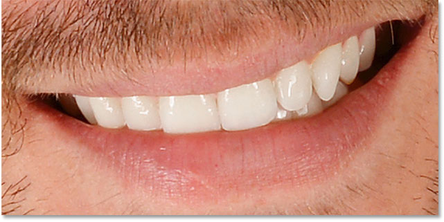 The teeth after whitening them in Photoshop and cleaning up the surrounding areas